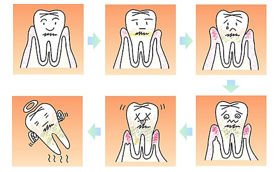 歯周病の進行の状態