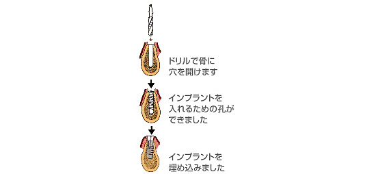 インプラント治療方法の埋め込み方 インプラント治療方法の埋め込み方